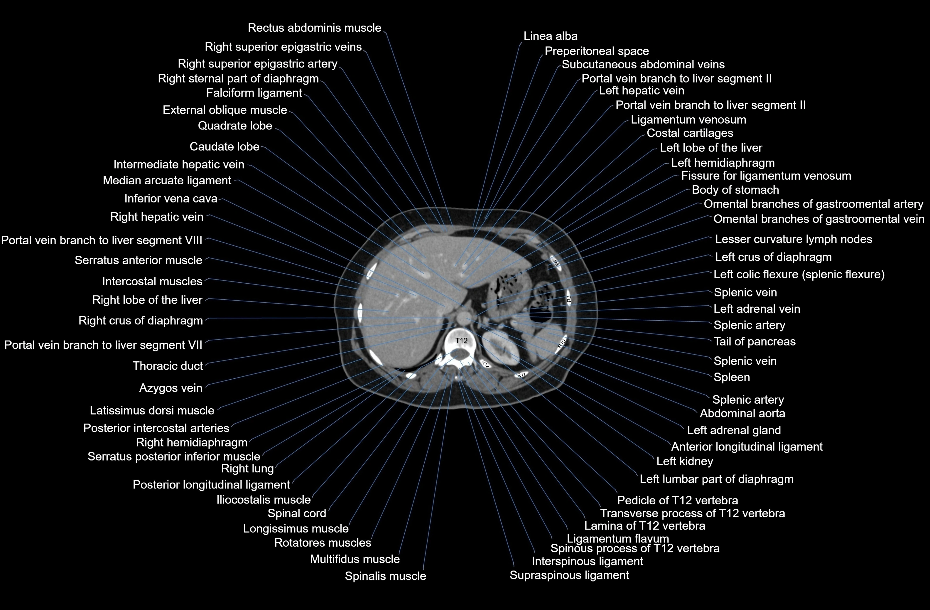 CT Abdomen axial cross sectional anatomy labelled radiology image-00019.webp